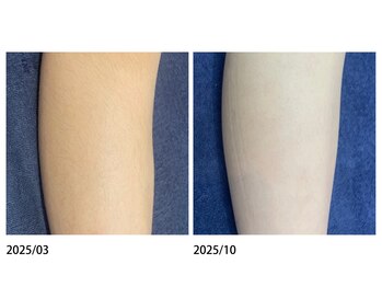 オーシャンブルー 佐世保店(OCEAN BLUE)/結果の出る脱毛【ひざ下】