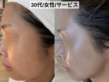 ハナコ 健軍店(HANAKO)/シミくすみ
