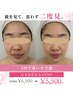 【1回で違いを実感】たるみ引上げEMSフェイシャル60分 ¥6,500→¥5,500