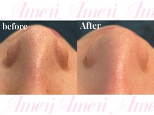 アメリ(Ameri)/毛穴洗浄 ¥5500