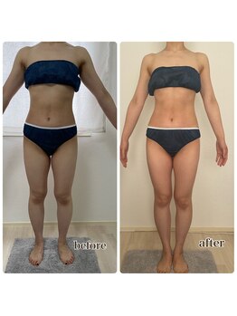 エステサロンブランシュ(Esthe salon Blanche)/ハイパーナイフ痩身