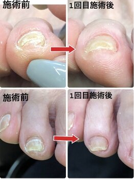 ラリベルテ(La liberte)/～巻き爪補正～