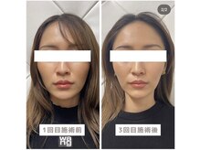 ヴィーライン 恵比寿本院(VeLine)/お客様Before After/小顔効果