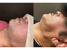 アイスタイル(i-style)/ひげ脱毛♪