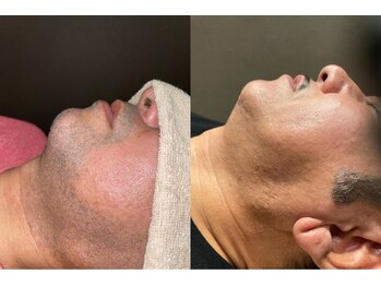 アイスタイル(i-style)/ひげ脱毛♪