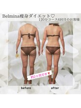 ベルミナ(Belmina)/大名/天神/毛穴/脱毛/痩身