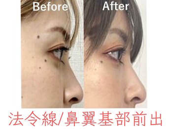 ラプリ 福岡博多店(Raplit)/隆鼻+輪郭・小顔矯正 美鼻/小顔