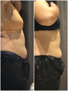 アイスタイル(i-style)/脂肪冷却/痩身ダイエット/泉大津