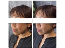 ラローズ(La Rose)/韓国シワたるみケア★サーマガン