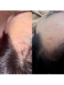 ラクーン 武蔵小杉(raccoon)/インディバヘッドスパで育毛促進