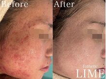 ベル 桜木町(Belle)/ハーブピーリング｜フェイシャル