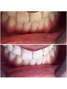 エクシアホワイトニング 代々木店/一回で驚きの白さに