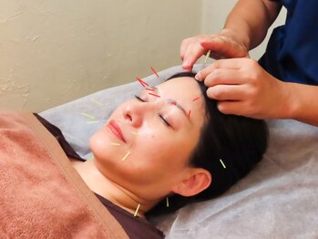 烏来 銀座店の写真/【美容鍼ご用意しております◎】顔のむくみが気になる、リフトアップしたい、そんな方にオススメです！