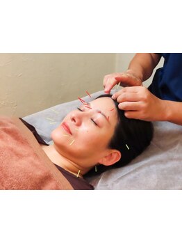 鍼灸施術を受けたい