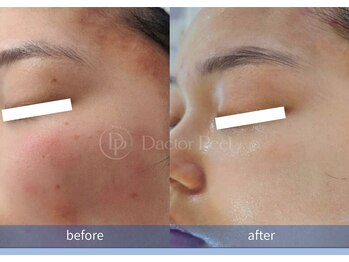 ハーシークレット(Her secret)/ダクトピール+毛穴洗浄