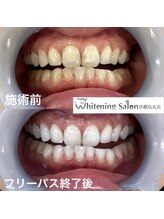 ホワイトニングサロン 京都烏丸店/ホワイトニング施術例