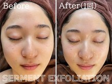 セレブリボーン 大阪ボーテ/セルマンピーリング