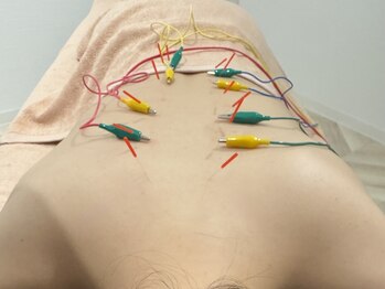 整体×美容鍼Body  Alfa【自律神経/肩こり】の写真/お肌のハリも身体の軽さも同時に叶える！美容鍼＆全身鍼で美と健康を引き出すトータルメンテナンス☆