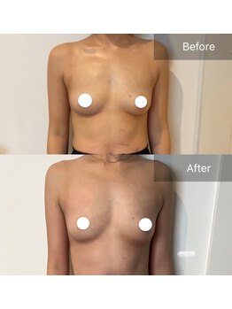 サロンツキ(salon tuki)/【バストアップ】症例★