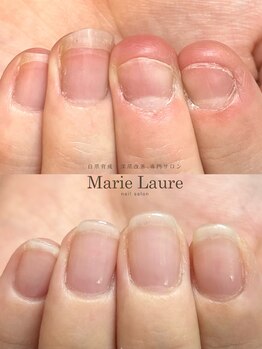 マリーロール 梅田店(Marie Laure)/自爪育成/深爪矯正/ネイルケア