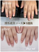 ティアラネイル 宇都宮/リプロネイル深爪矯正コース