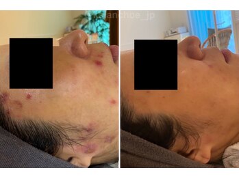 カランコエ(KALANCHOE)/ずっと繰り返している広範囲にも