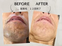 ワンアップ(One-up)/ヒゲ脱毛 12回完了before  after