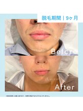 メンズクリア 藤沢OPA店/【メンズクリア】お客様の施術例