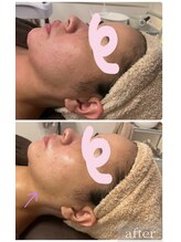 リリールア(Rere-Rua)/美肌ケア