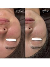 エクラ(eclat)/美白はもちろん！赤ら顔の改善！