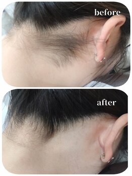 エタニティ 西宮店(Eternity)/うなじ・背中脱毛