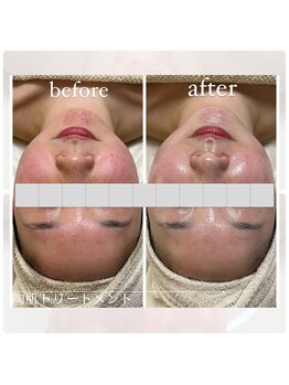 アチェリー(aCherry)/陶肌トリートメント