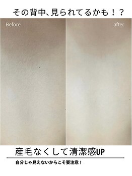 エイチケービューティーサロン(H/K beauty salon)/【夏まえに脱毛】