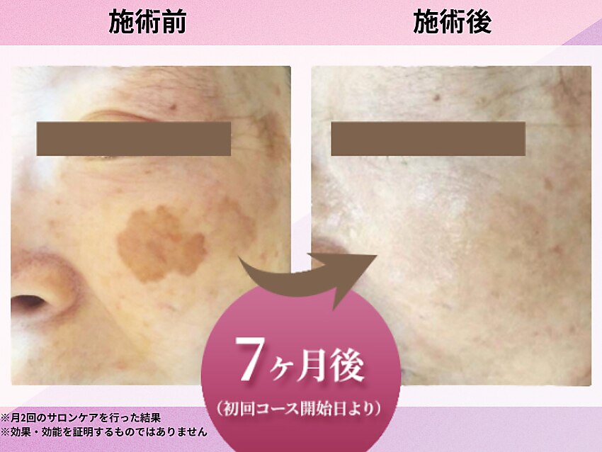 フォト｜クリニカルエステ花蔵 スズラン高崎店｜ホットペッパー