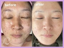 ビューティルーム アム(BEAUTY ROOM amu)/ピーリング　ビフォーアフター