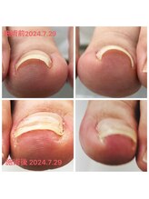 ココネ(cocone)/巻き爪解放ケア