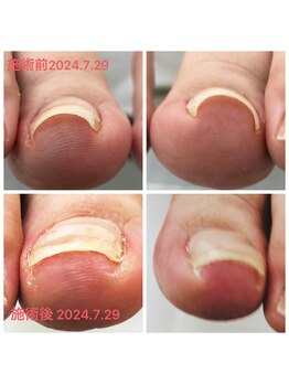 巻き爪解放ケア