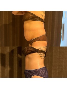 カシェット(cachette)/ウルトランスフォーマー痩身