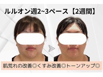 ヨサパーク ラ ぺ(YOSAPARK La paix)/繰り返すほど美肌に導く！