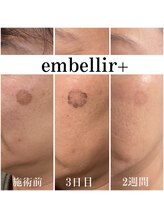 アンベリールプラス(embellir+)/シミがなくなり美白に