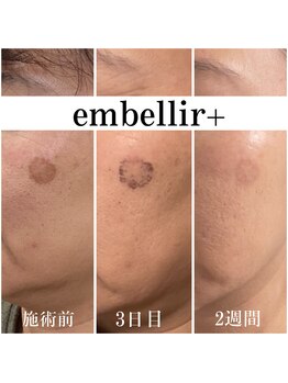 アンベリールプラス(embellir+)/シミがなくなり美白に
