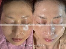 ルミア(LUMIA)の雰囲気（年齢によるたるみ・ほうれい線を集中改善）