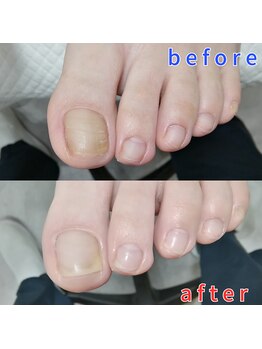 【肥厚・変形爪】ネイル/フット