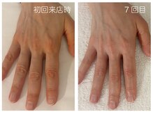 キレイテ 上野店/50代/7回目【ハンドケア上野】