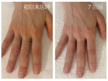 キレイテ 上野店/50代/7回目【ハンドケア上野】