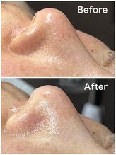 ティーツリー 名古屋 桜山(Tea Tree)/一見、黒ずみではなさそうだけど