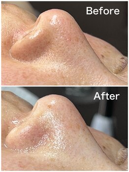 ティーツリー 名古屋 桜山(Tea Tree)/一見、黒ずみではなさそうだけど