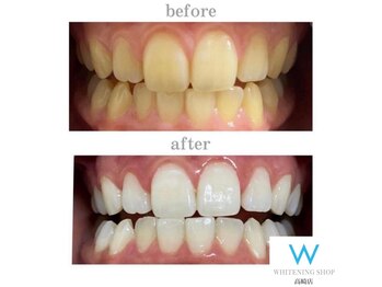 ホワイトニングショップ 高崎店/ビフォーアフターホワイトニング