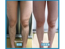 米粒を投げられたぐらいの痛み！少回数での脱毛効果に自信アリ！