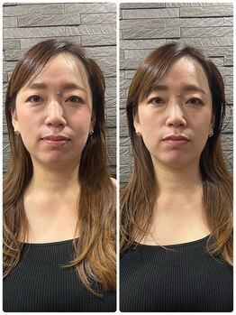 長寿鍼灸院 長寿整骨院/ハリネズミ女優美容鍼効果★